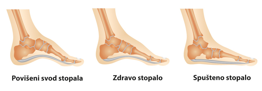 Simptomi i liječenje stopala osteoartritisa